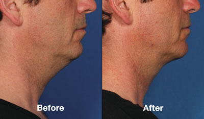 Before & After Kybella