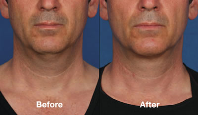 Kybella Before & After