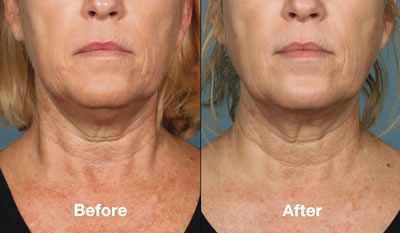 Kybella Before & After