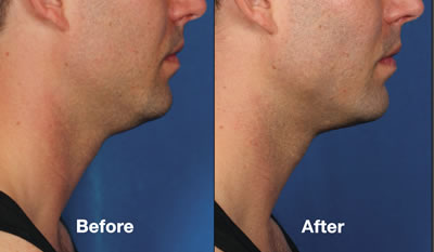 Before & After Kybella