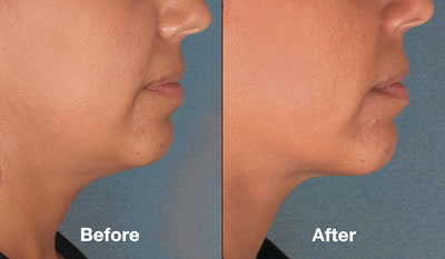 Before & After Kybella