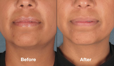 Before & After Kybella