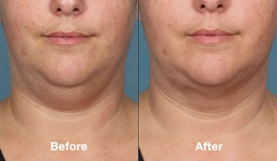 Before & After Kybella